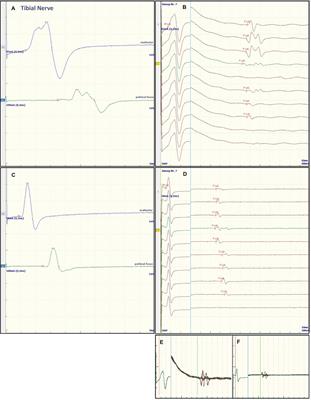 Case report: A 33 years-old alcoholic male with diarrhea and progressive muscle weakness mimicking Guillain–Barré syndrome